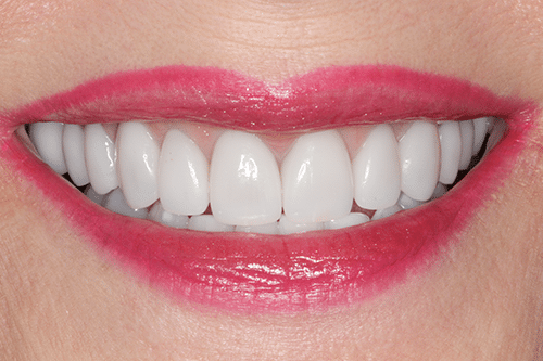 case 3- Porcelain Veneers After