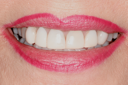 case 3- Porcelain Veneers Before