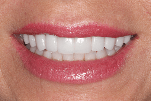 case 4- Porcelain Veneers After