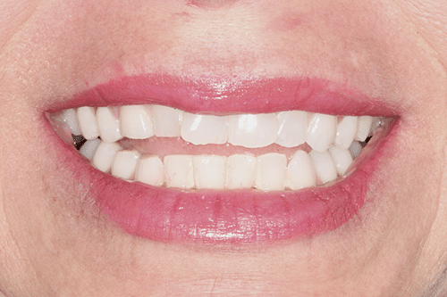 case 4 -Porcelain Veneers Before