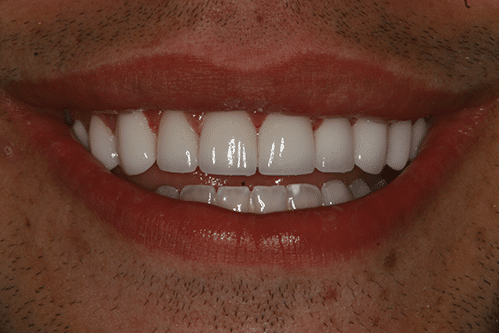 case 5- Porcelain Veneers After