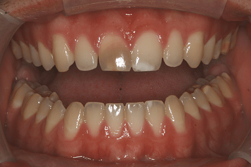 case 5 Porcelain Veneers Before