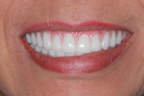 after close up of patient smile