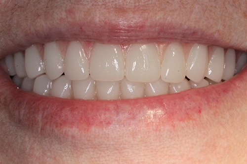 After Treatment