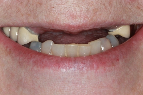 Before Treatment