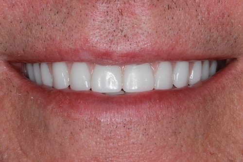 After Treatment