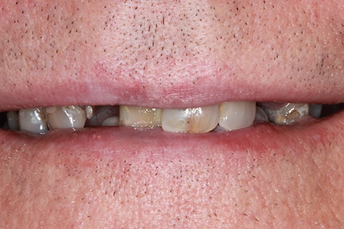 Before Treatment