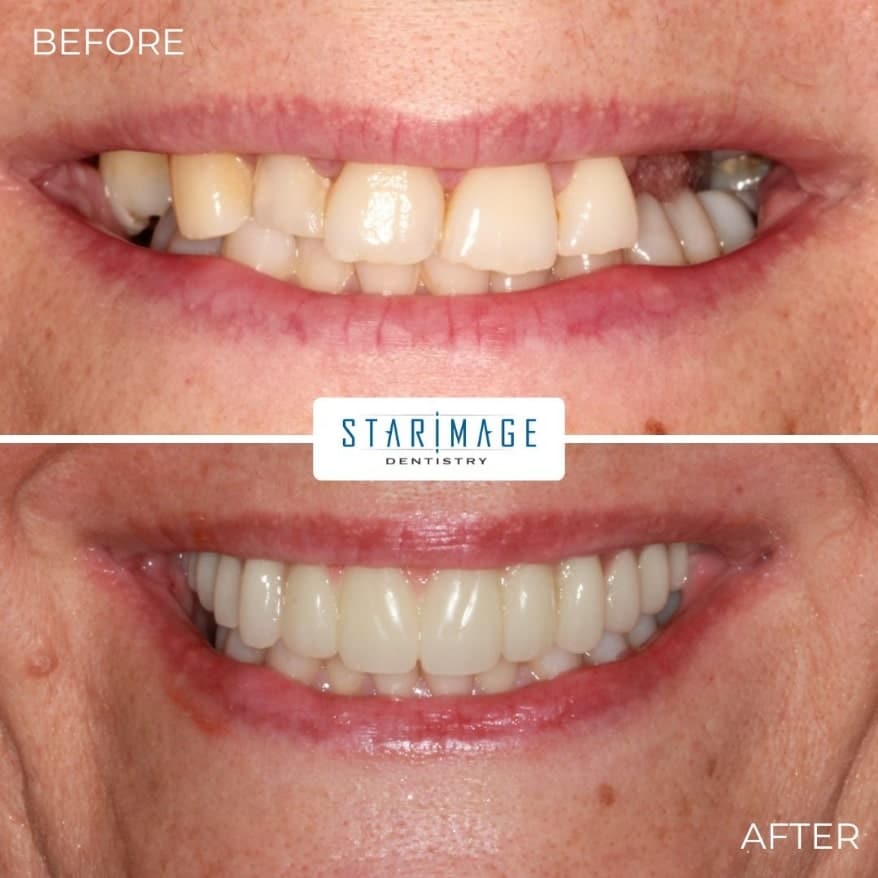 before and after comparison of replacement teeth showing full mouth dental implants