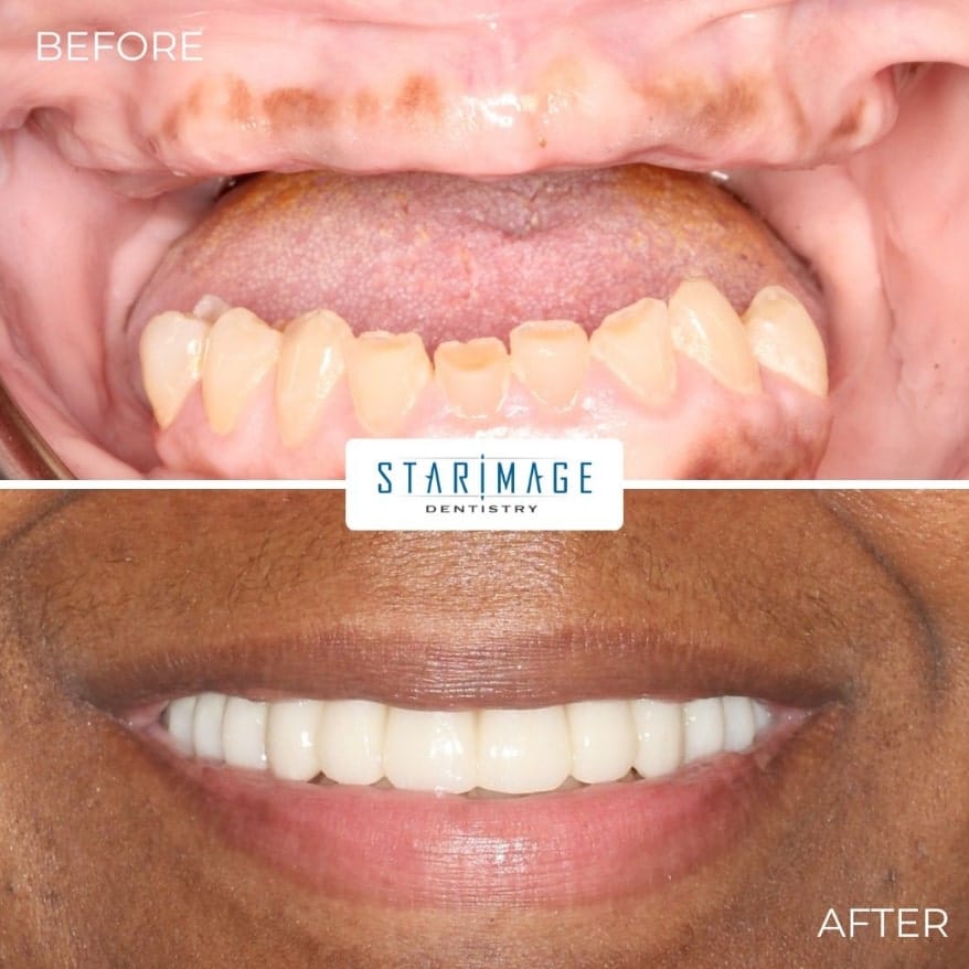 no upper teeth replaced with full mouth dental implants.