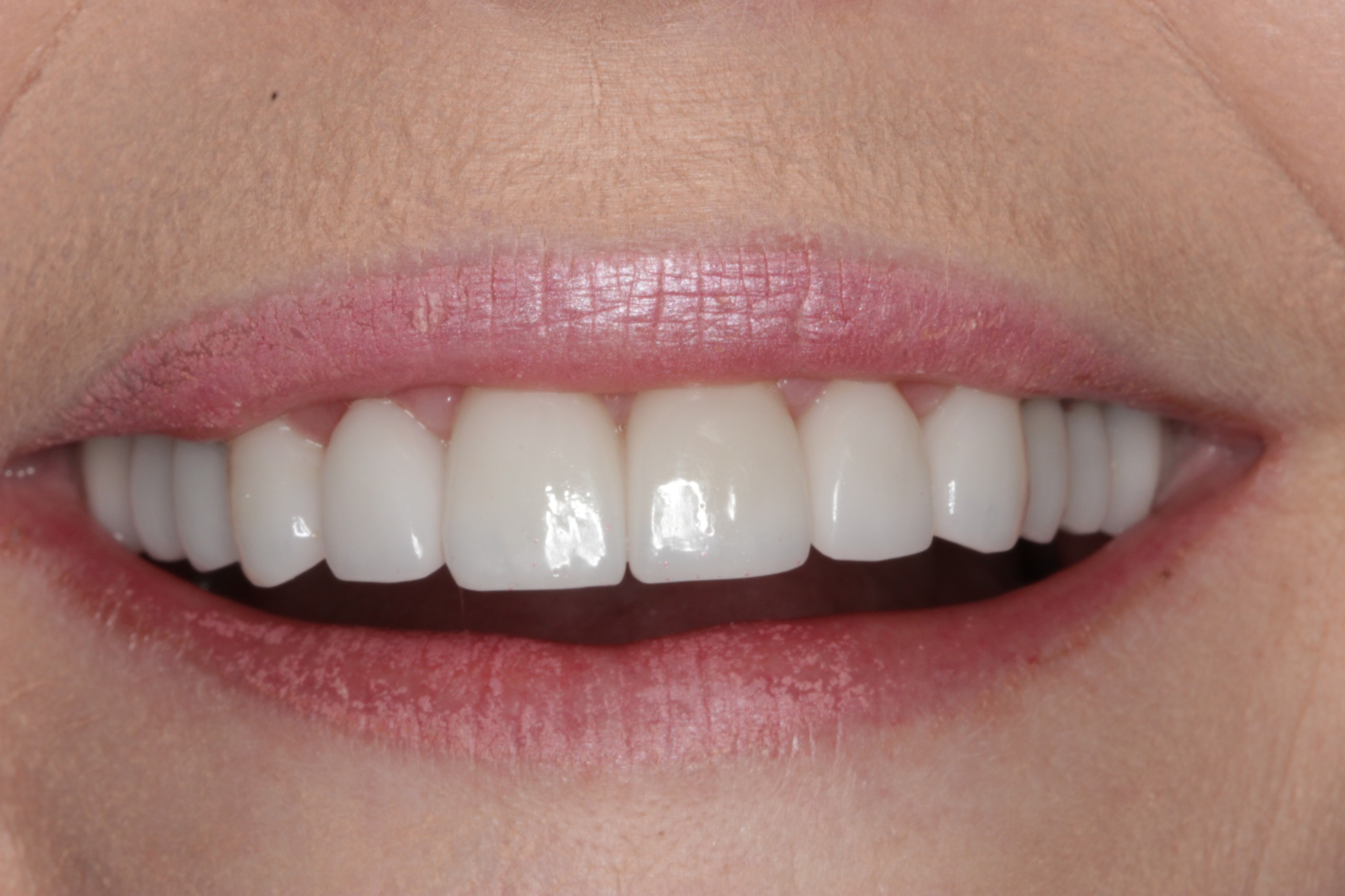 laser gum treatment after