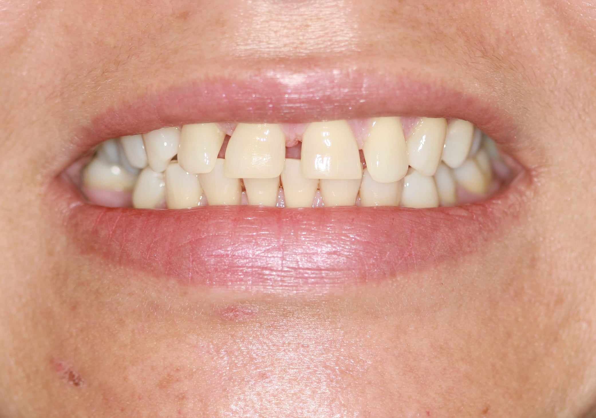 Before Treatment
