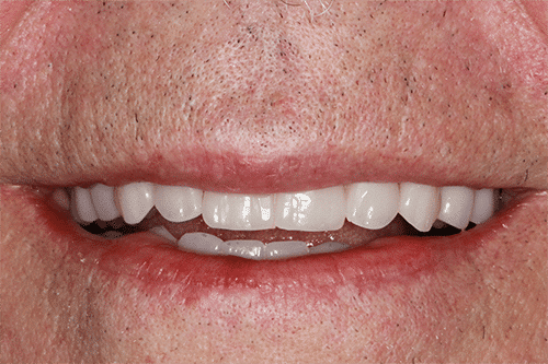 closeup of a man's smile after teeth in a day treatment