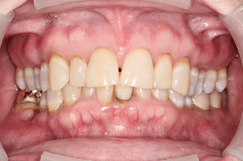 close up of teeth and gums before treatment