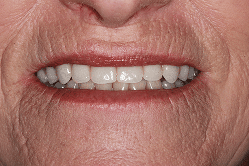 New You Dentures Patient 3 after