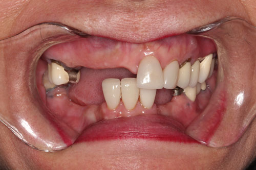 before closeup image of patient smile