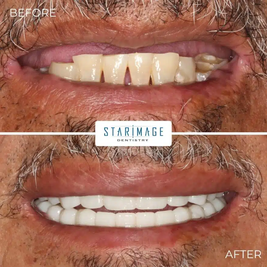 before and after comparison of full mouth dental implants
