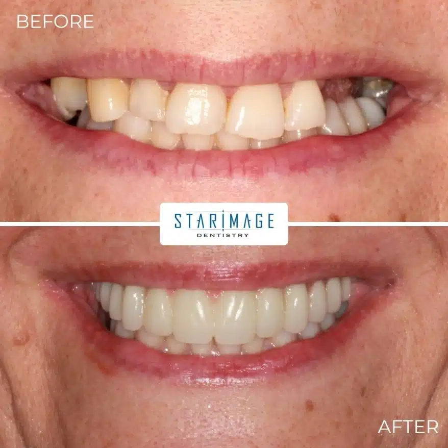 before and after comparison of replacement teeth showing full mouth dental implants