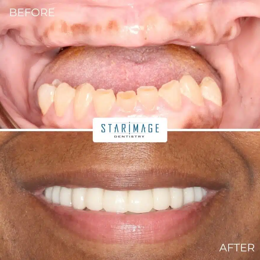 no upper teeth replaced with full mouth dental implants.